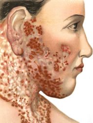 Un dos síntomas máis habituais son as erupcións na pel